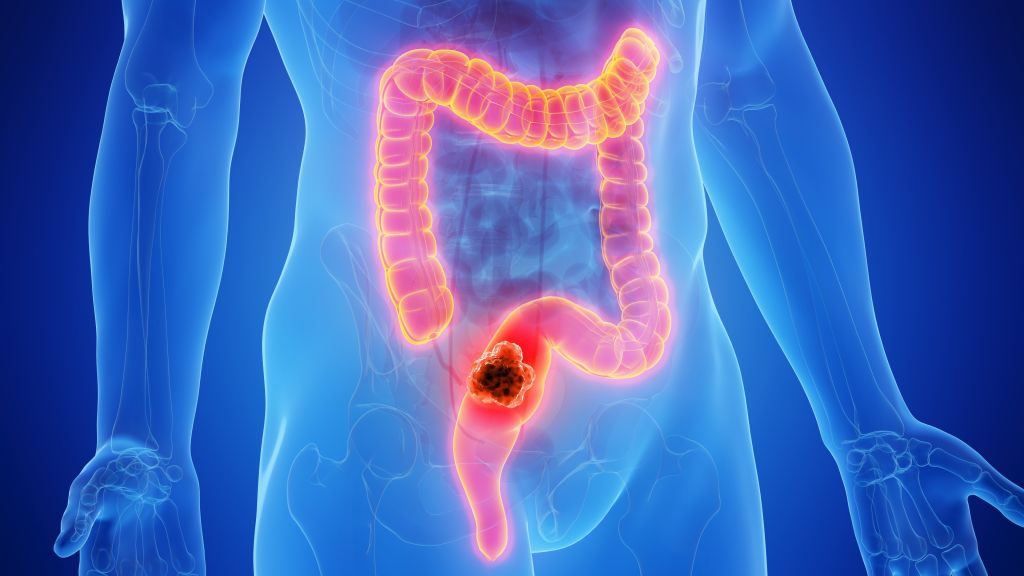 Colorectal cancer illustration