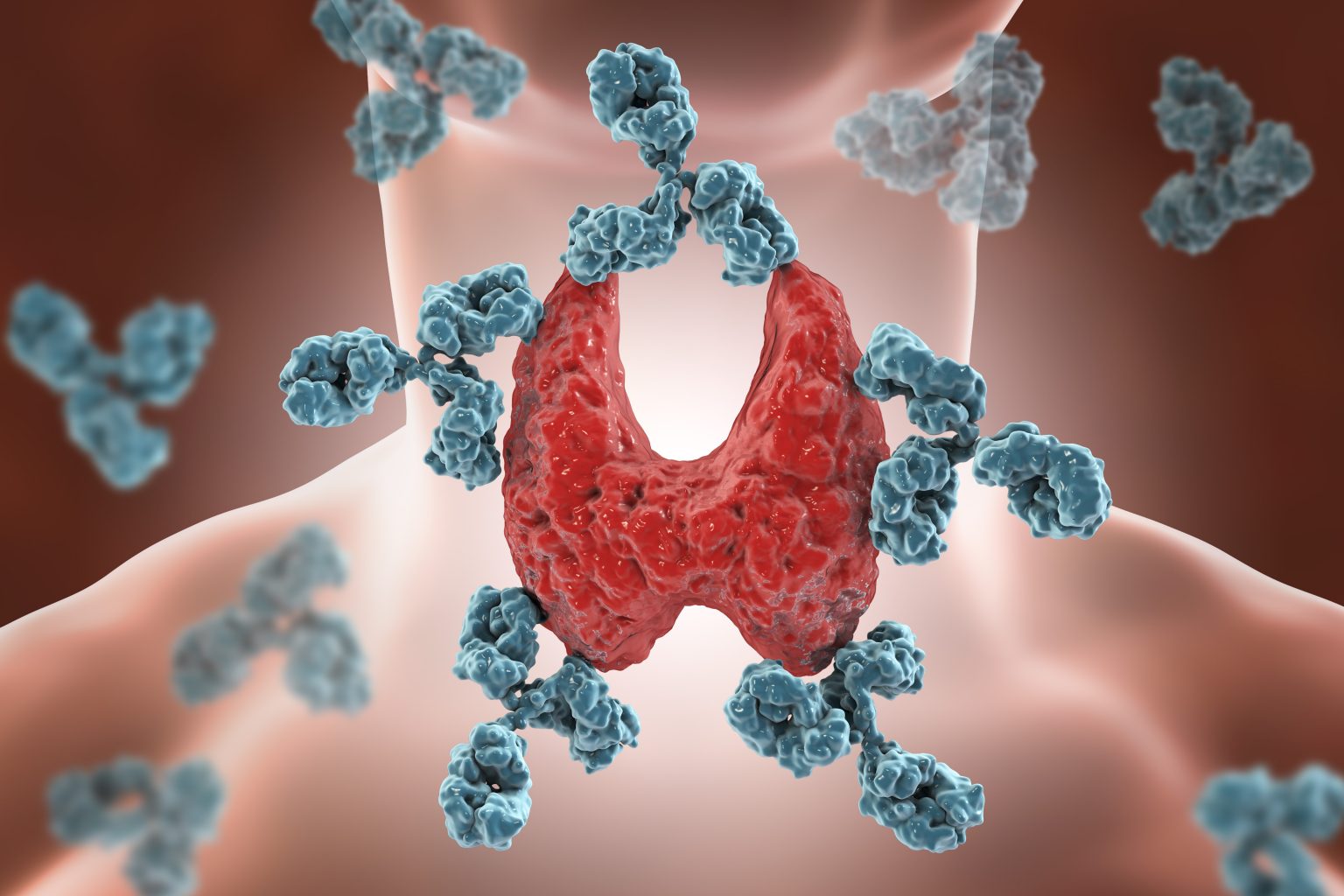 Hashimoto’s disease concept