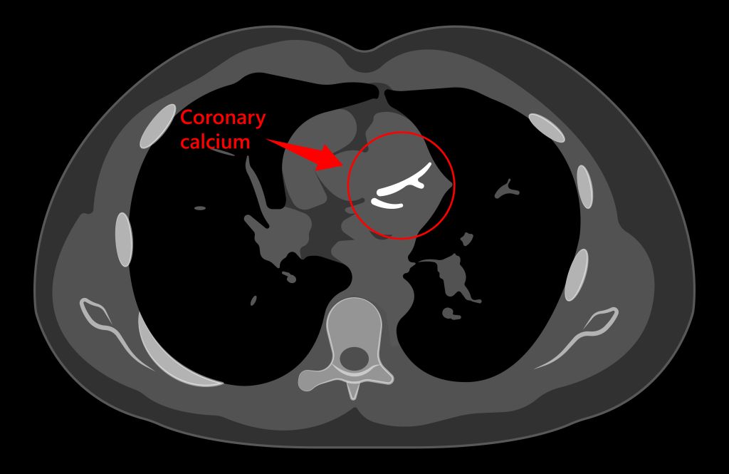 Cardiac calcium test  