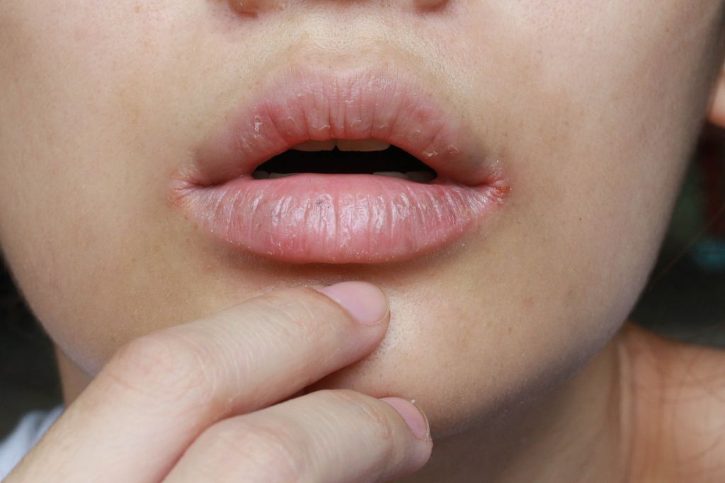 Cracked corners of the mouth