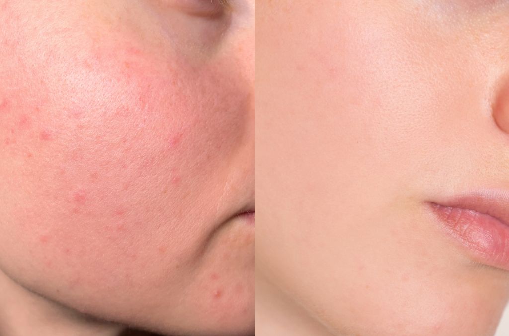Skin improving