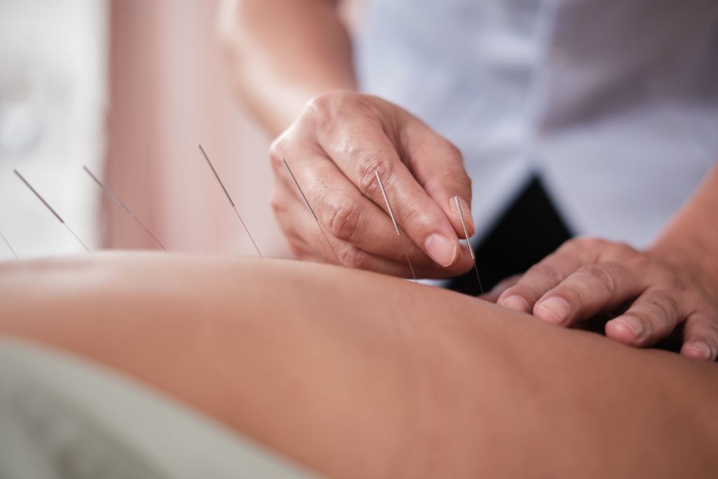 Woman undergoing acupuncture 