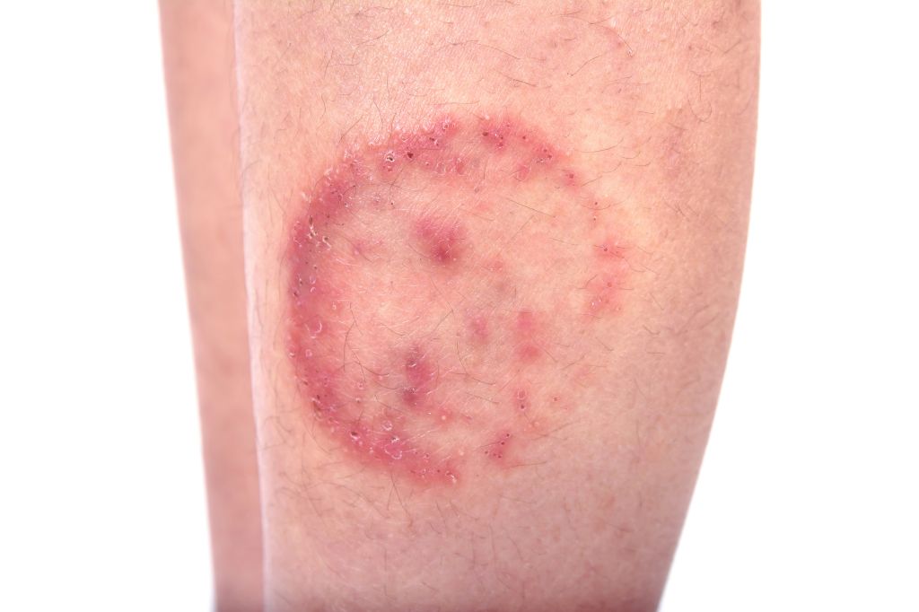 Ringworm on leg