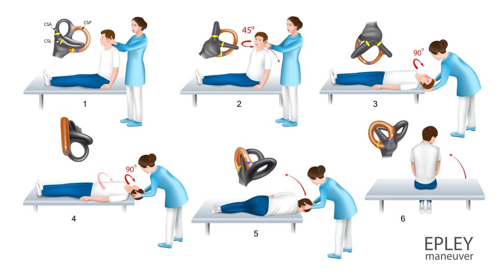 Epley maneuver