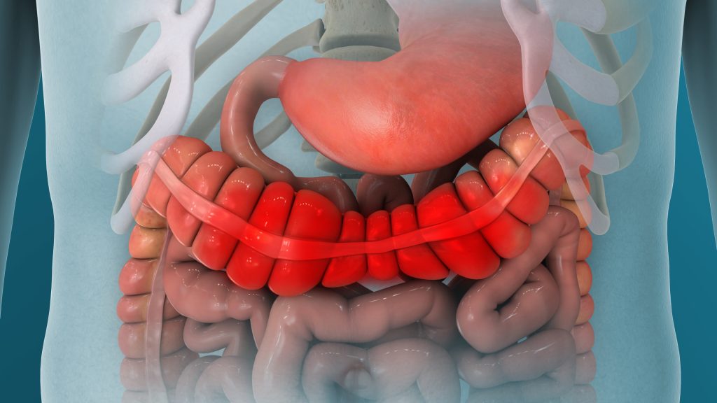 Bowel inflammation