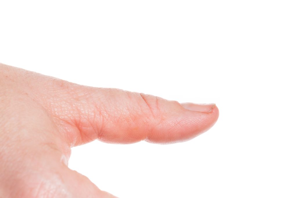 Spoon nail close-up