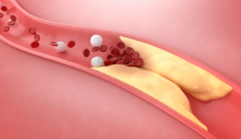 Thickened arteries illustration