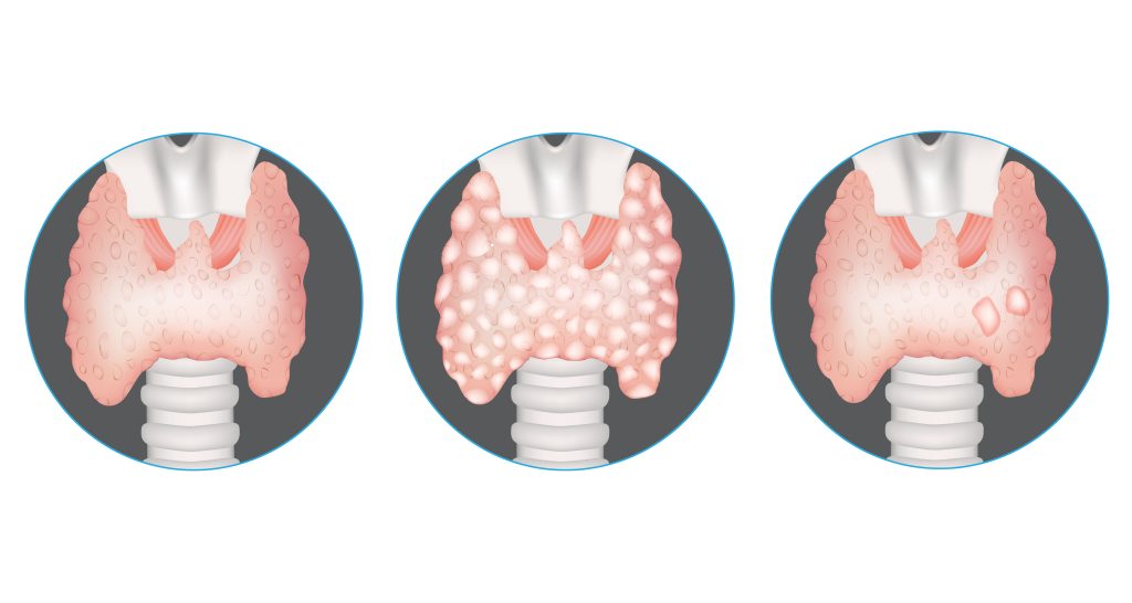Thyroid nodules