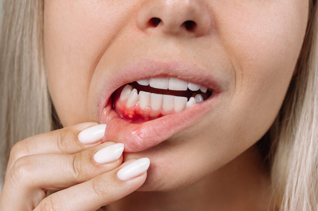 Woman with gum disease