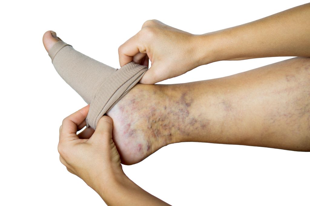 Woman putting on compression stockings