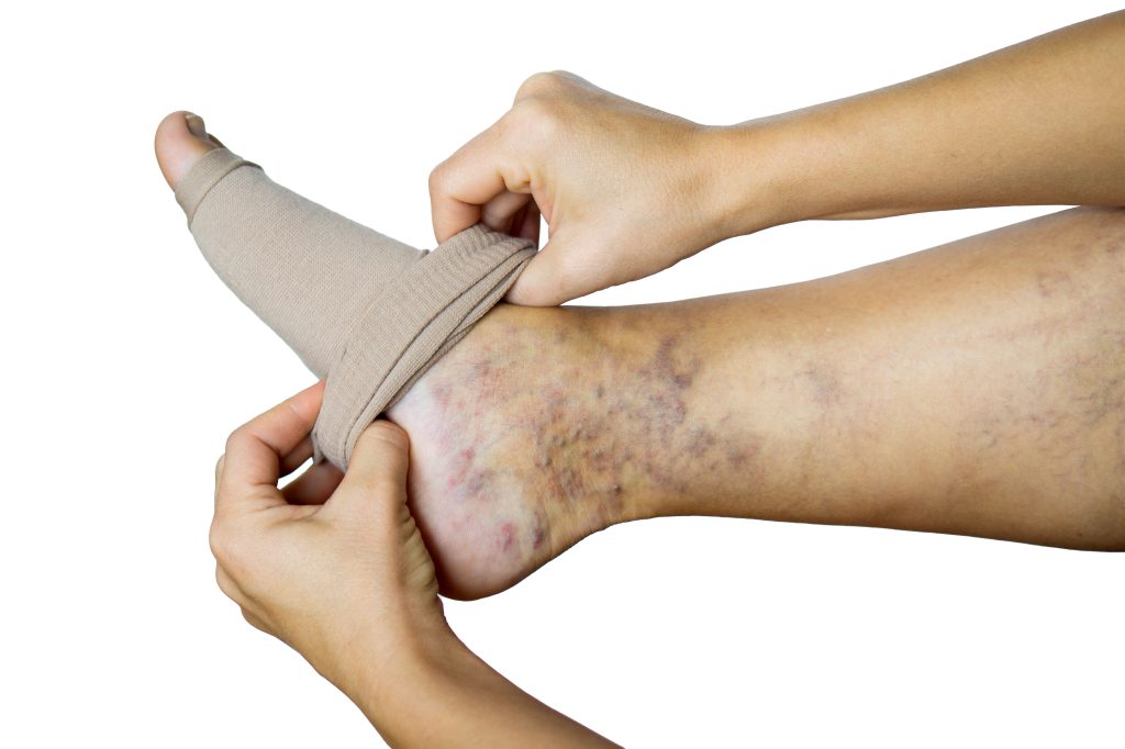 Woman putting on compression stockings