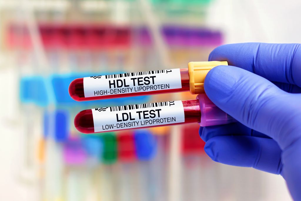 HDL and LDL blood sample 