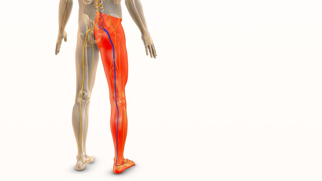 Sciatica concept  