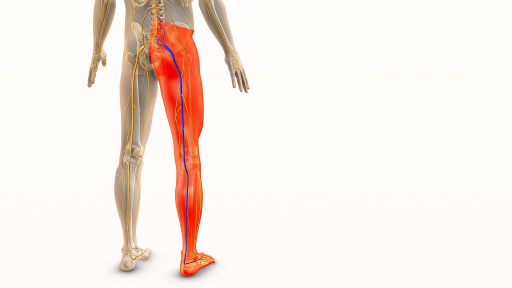 Sciatica concept