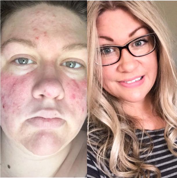 Before and after face image of Carissa Kelly